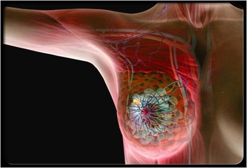 Kanceri i gjirit në trupin human